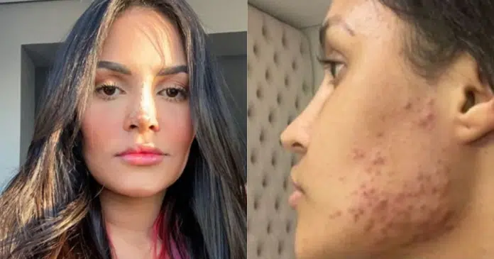 Ex-BBB Flay relata problemas com ‘chip da beleza’: “Minha pele foi minha maior tristeza”