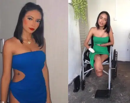 asomadetodosafetos.com - Jovem que teve membros amputados devido à infecção urinária conta sua história em vídeo