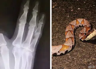Homem picado por cobra amputa o próprio dedo, mas descobre que não precisava