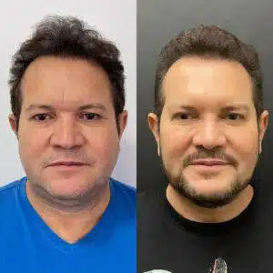 asomadetodosafetos.com - Ximbinha passa por transformação com harmonização facial; Confira o antes e depois