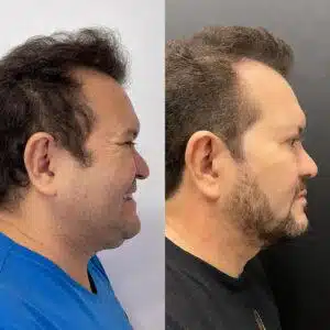asomadetodosafetos.com - Ximbinha passa por transformação com harmonização facial; Confira o antes e depois