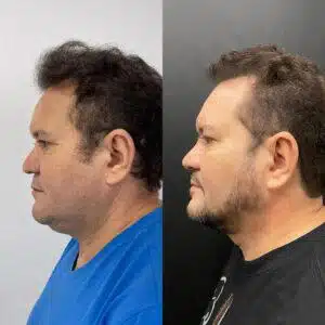 asomadetodosafetos.com - Ximbinha passa por transformação com harmonização facial; Confira o antes e depois